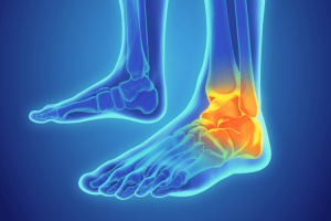 Ankle sprain